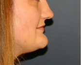 Feel Beautiful - Chin Reduction And Liposuction Beneath The Chin 205 - Before Photo